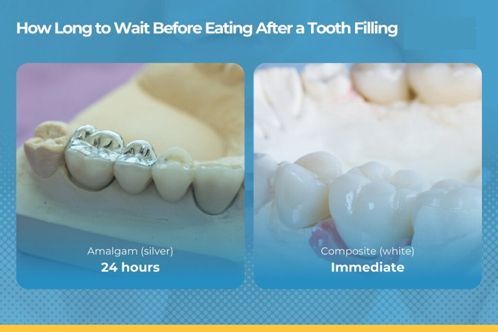 How Long After a Tooth Filling Can You Eat