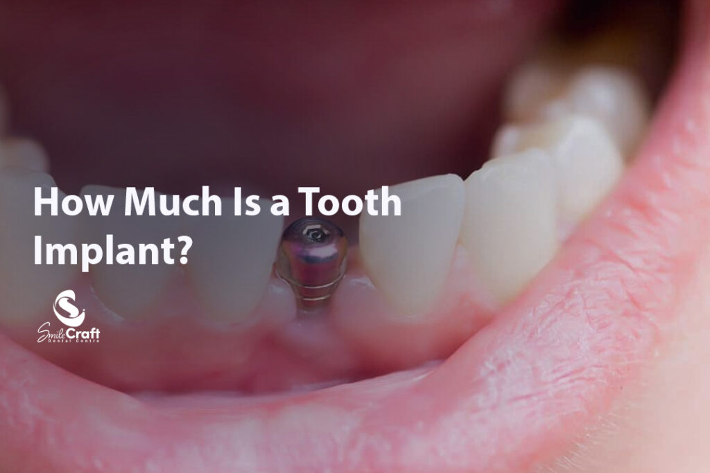 How Much Is a Tooth Implant