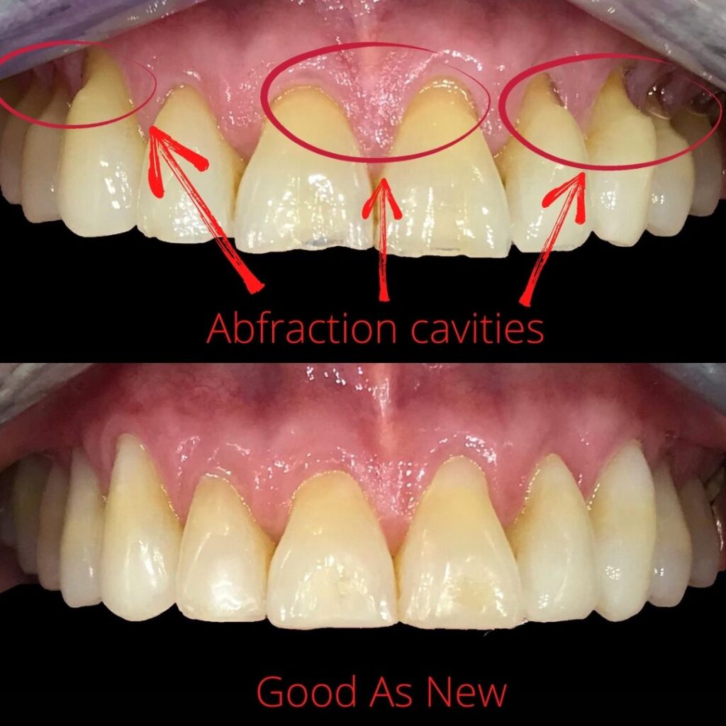 How to Stop Sensitive Teeth Pain Immediately
