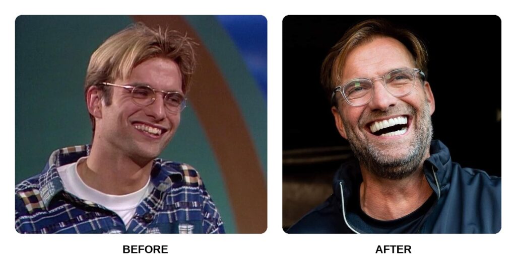 Jurgen Klopp Teeth
