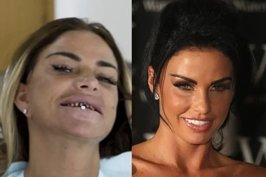 Katie Price Teeth