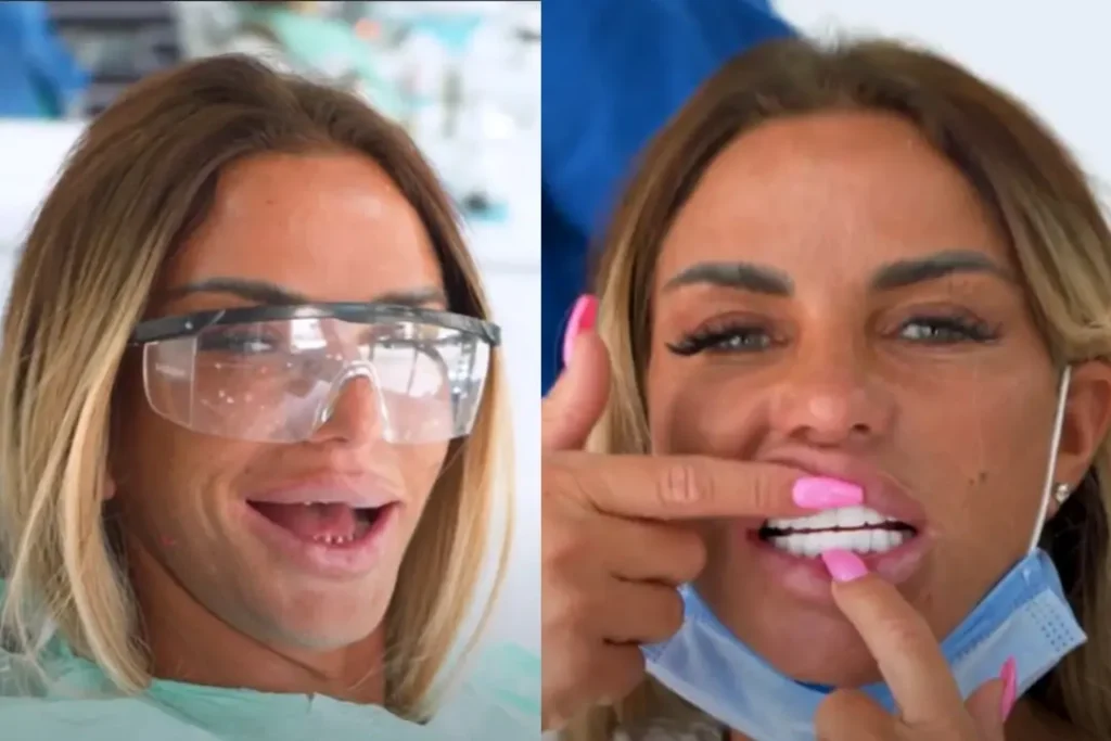 Katie Price Teeth