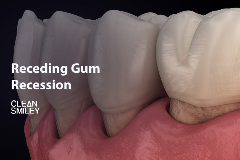 Receding Gum Recession