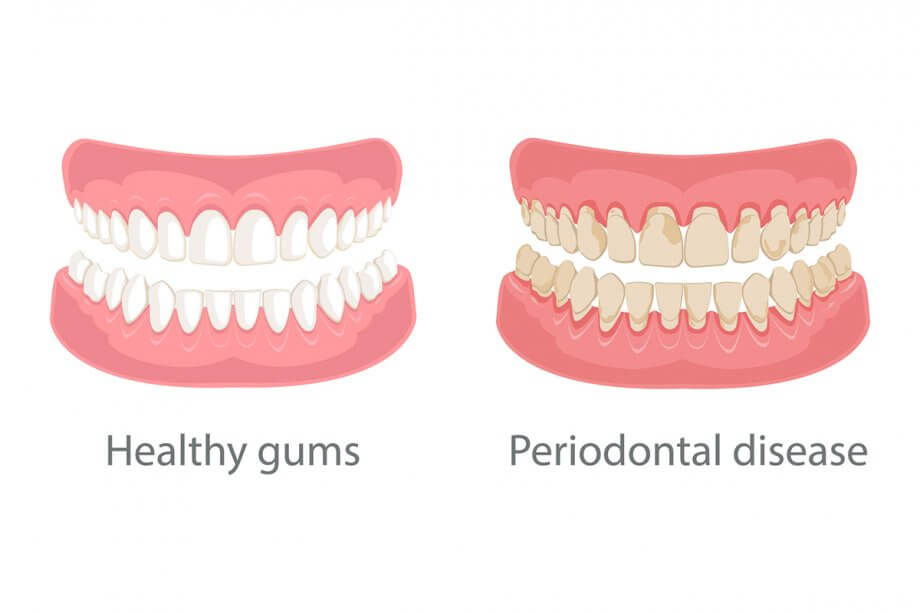 Receding Gum Recession