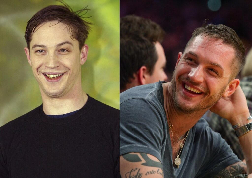 Tom Hardy's Teeth