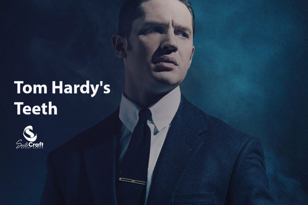 Tom Hardy's Teeth