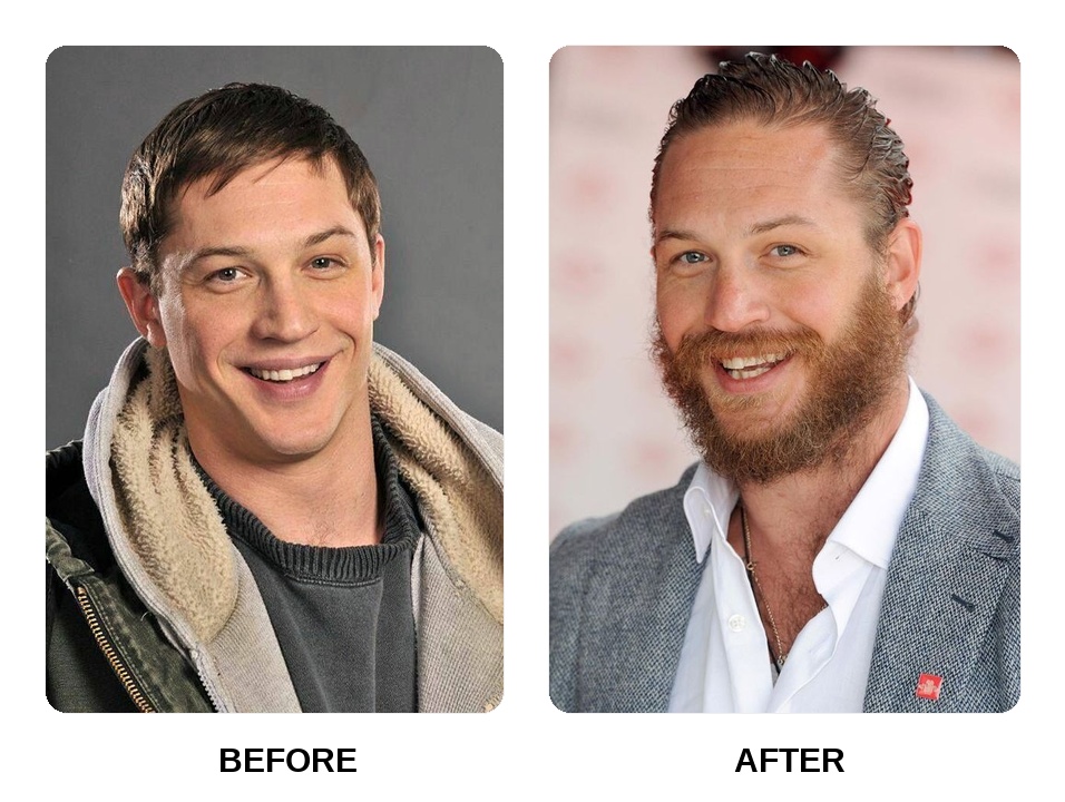 Tom Hardy's Teeth