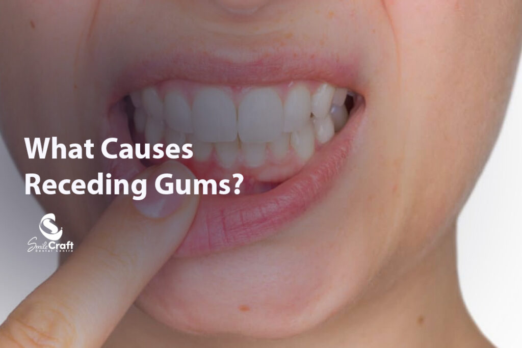 What Causes Receding Gums