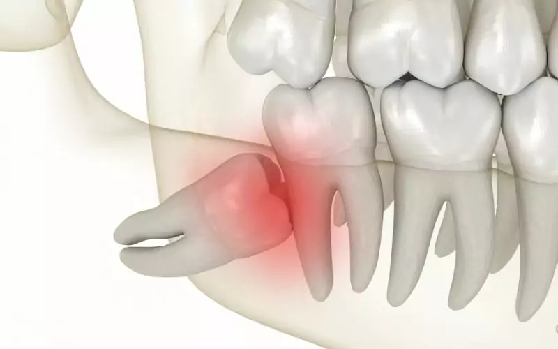 Wisdom Tooth Pain